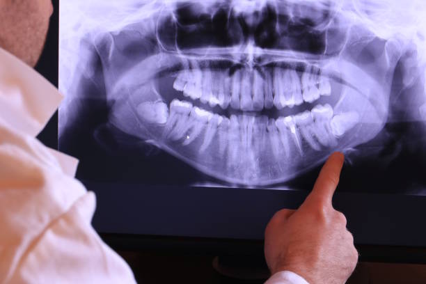 Best Emergency Wisdom Teeth Removal in Sprague, WV